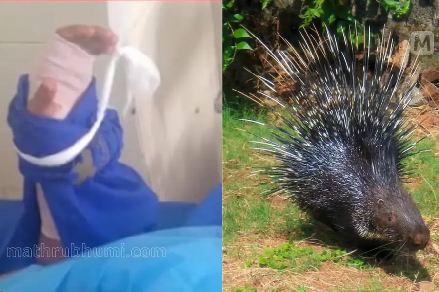 Porcupine attack in Kannur leaves Plus One student injured with 12 quills