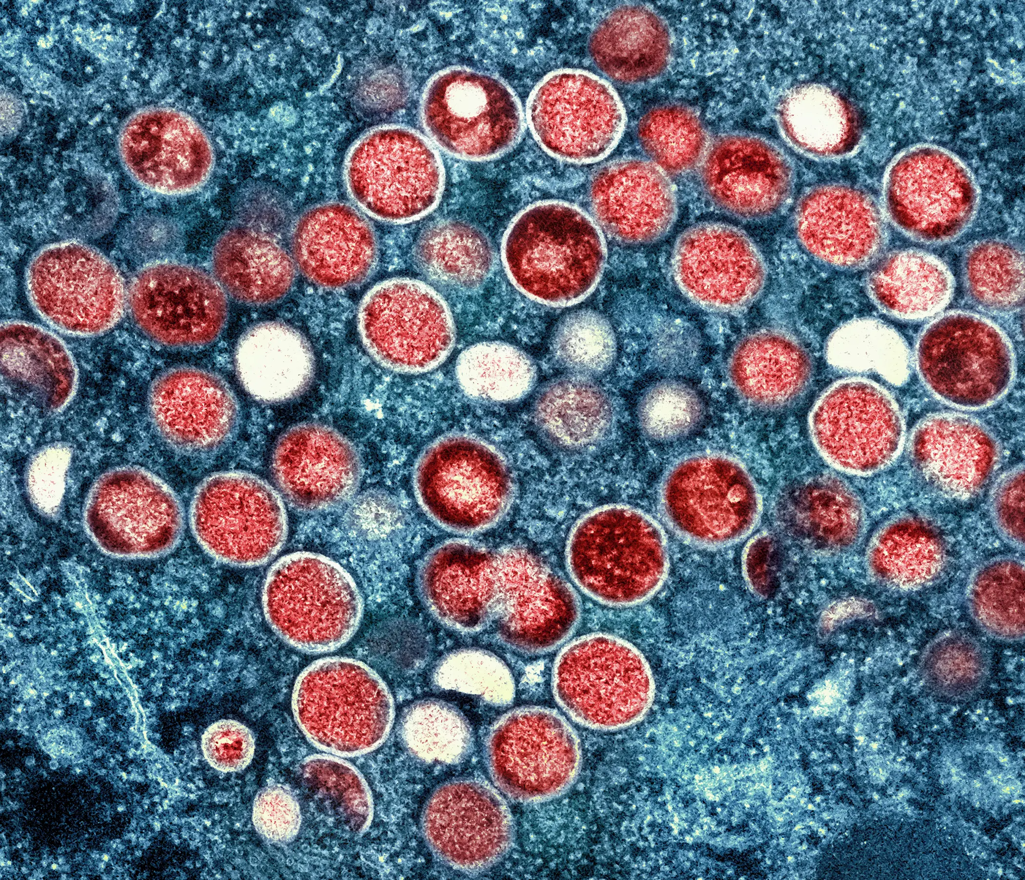A colorized transmission electron micrograph of monkeypox particles | Photo: AP