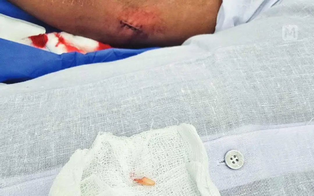 Stitched wound, piece of tooth can be seen lying in the background. | Photo: Arranged