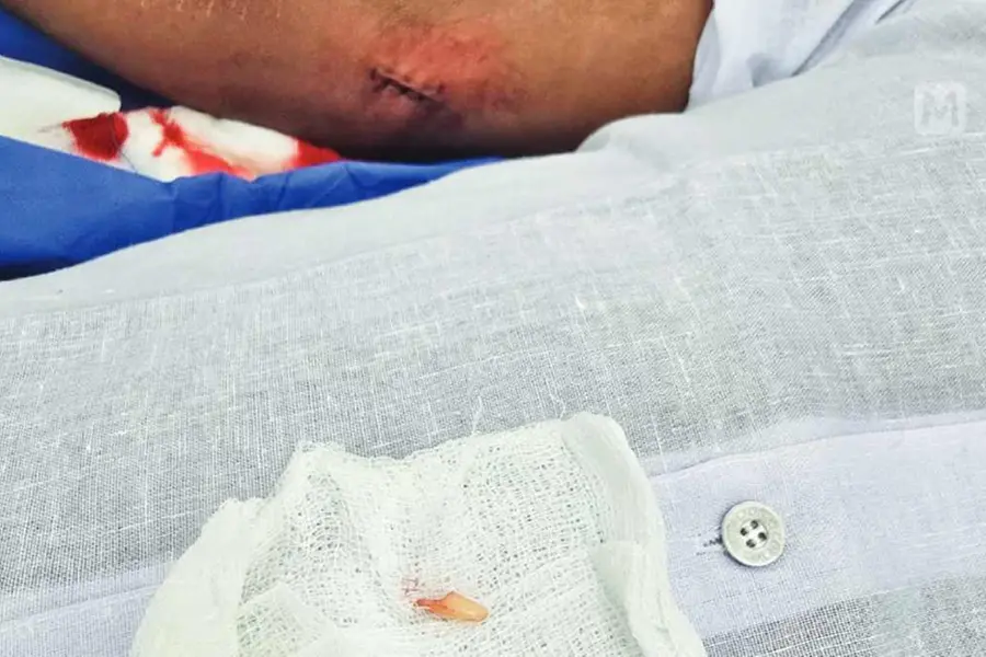 Truth comes out in the form of a dog tooth: Reason for Alappuzha man’s 25-year-long ordeal found