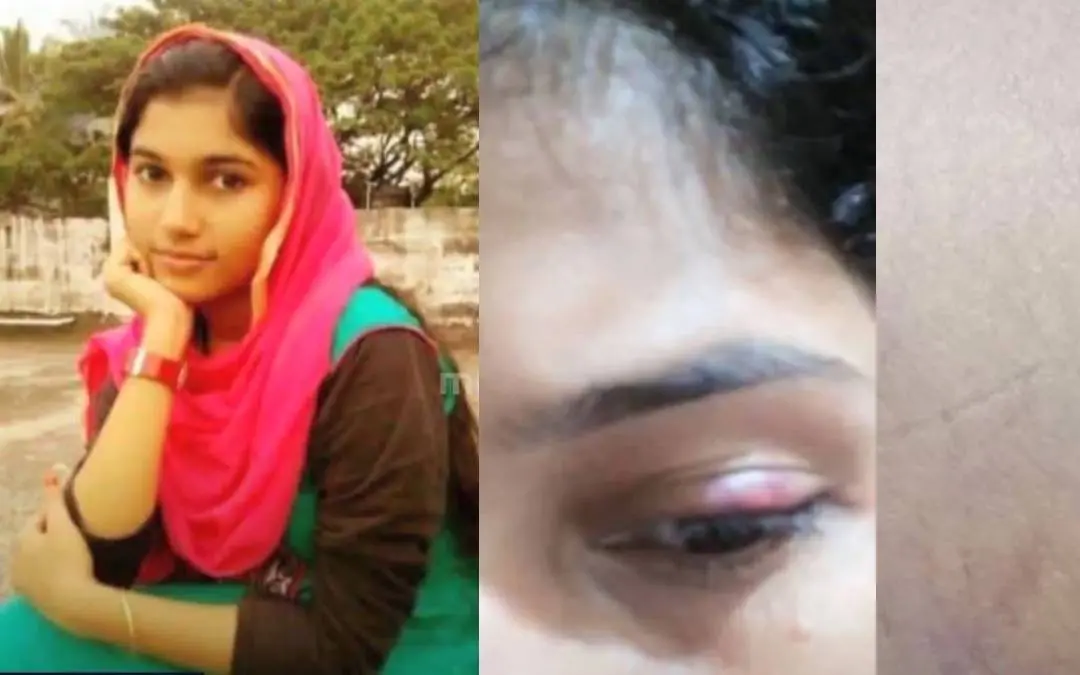 Afeeliya, picture of bruise shared to sister
