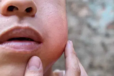 Mumps outbreak among school students in Kerala; experts suspect new variant