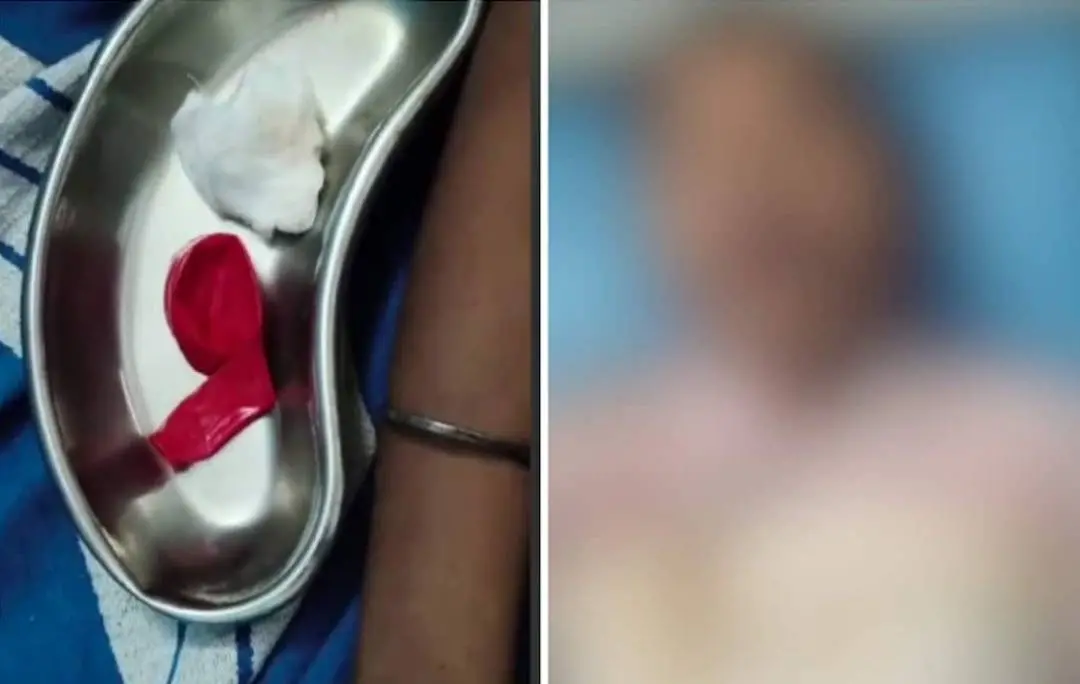 The balloon that was removed from the throat of the teenage boy; the boy at hospital
