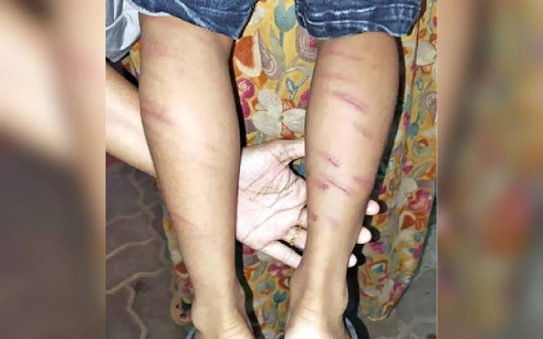 The marks of thrashing on the leg of the UKG student in Thrissur