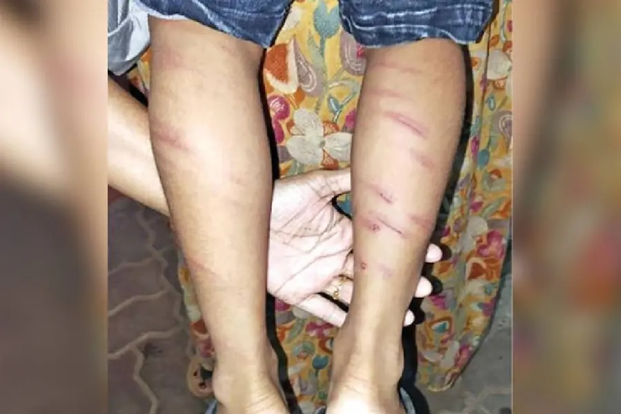 UKG student brutally caned at Thrissur school; teacher at large