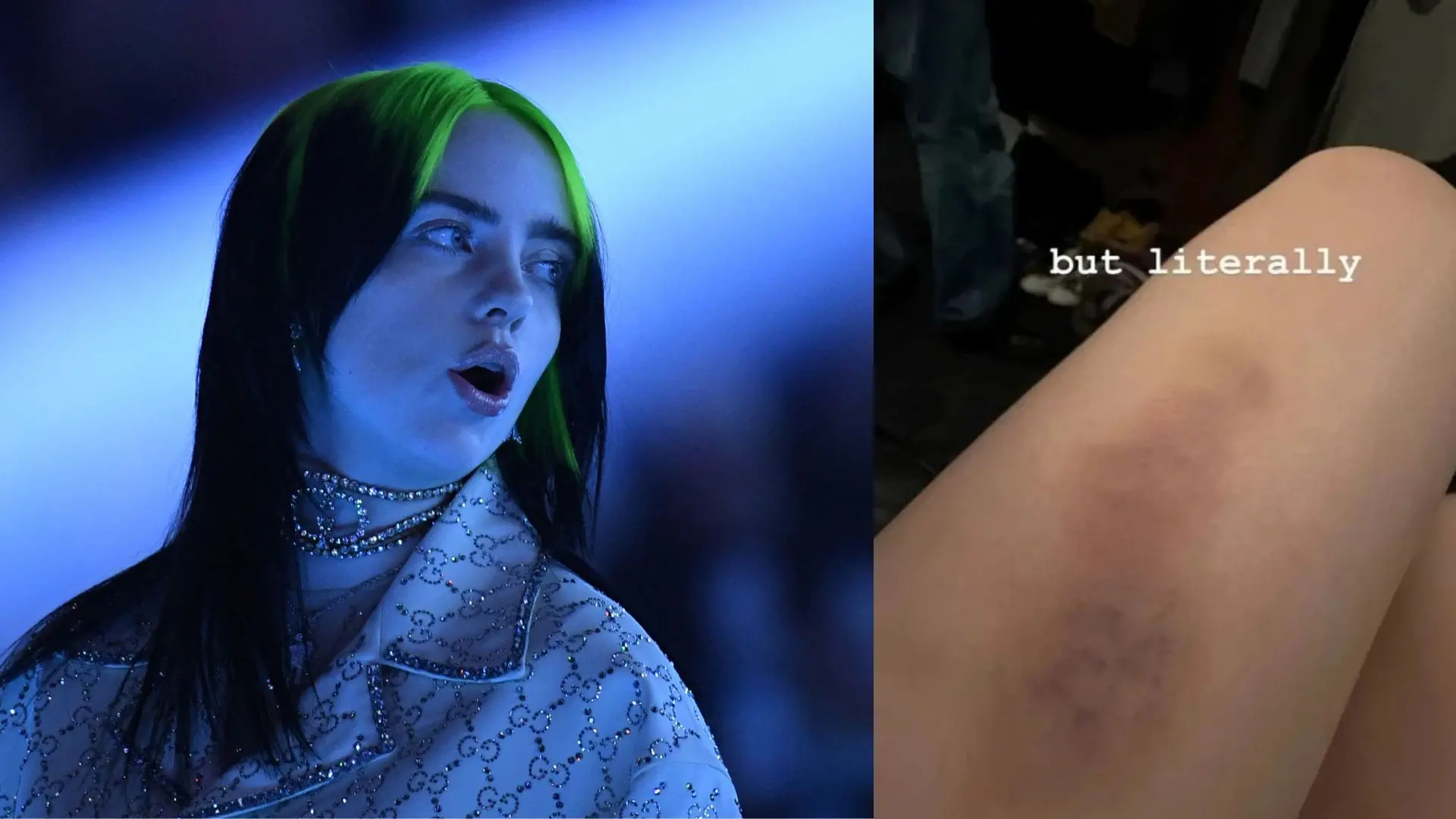 Billie Eilish, the injury on her leg | Photos: AFP, X