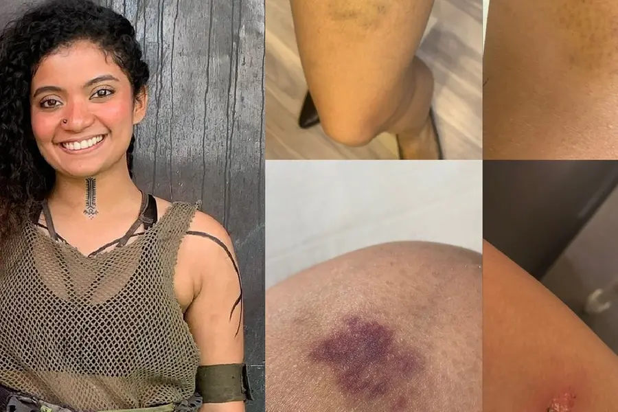 Bruised legs, cuts: Anna Ben's days in 'Kalki 2898 AD' set | See pics