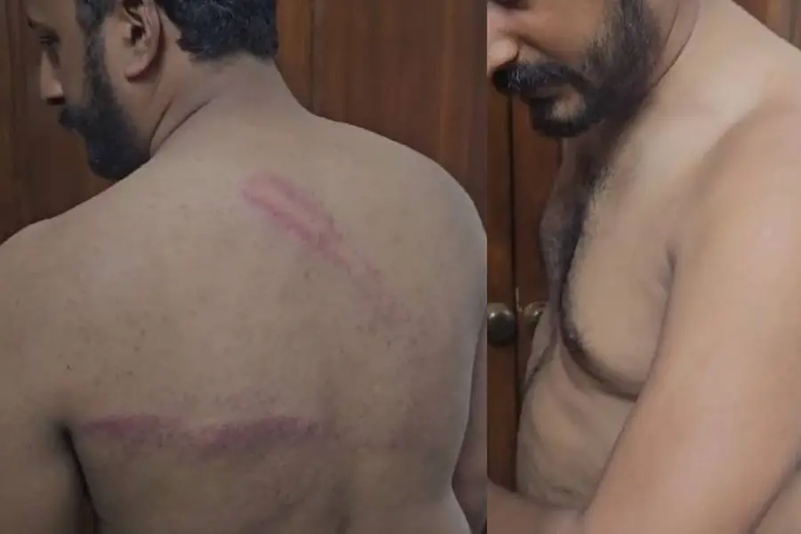 Youth Congress protest march against NEET Paper Leak turns violent; Rahul Mamkootathil injured