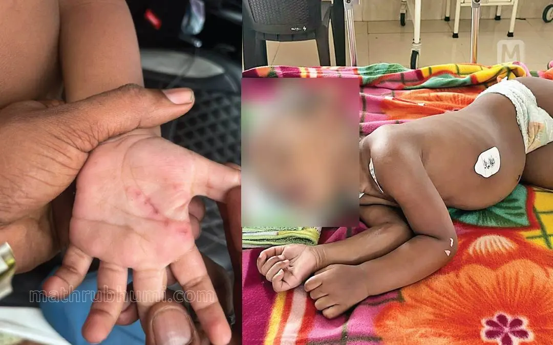 Ishan's left hand that suffered burns, the toddler was admitted to the Kottayam Medical College Hospital after the incident