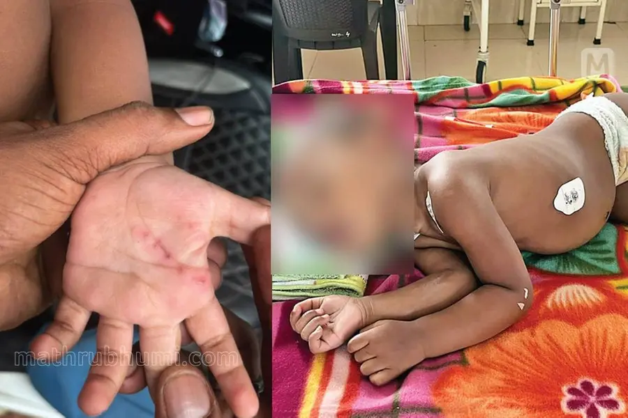 Cherthala toddler suffers burn injuries after 11kV line mishap