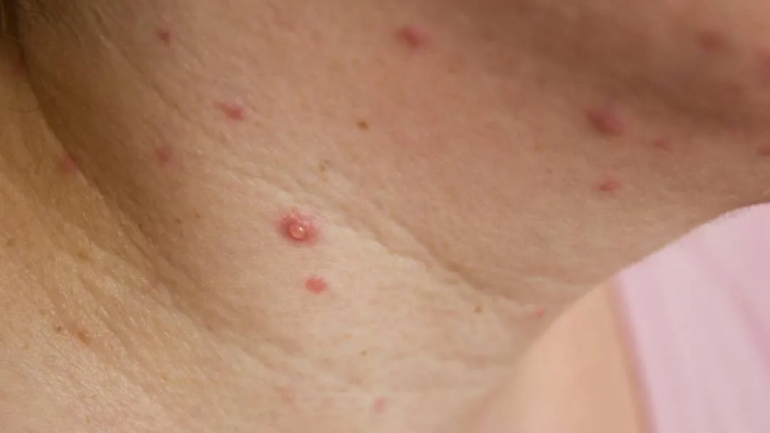 Chicken pox cases increase rapidly in Kasaragod district, officials ask public to exercise caution
