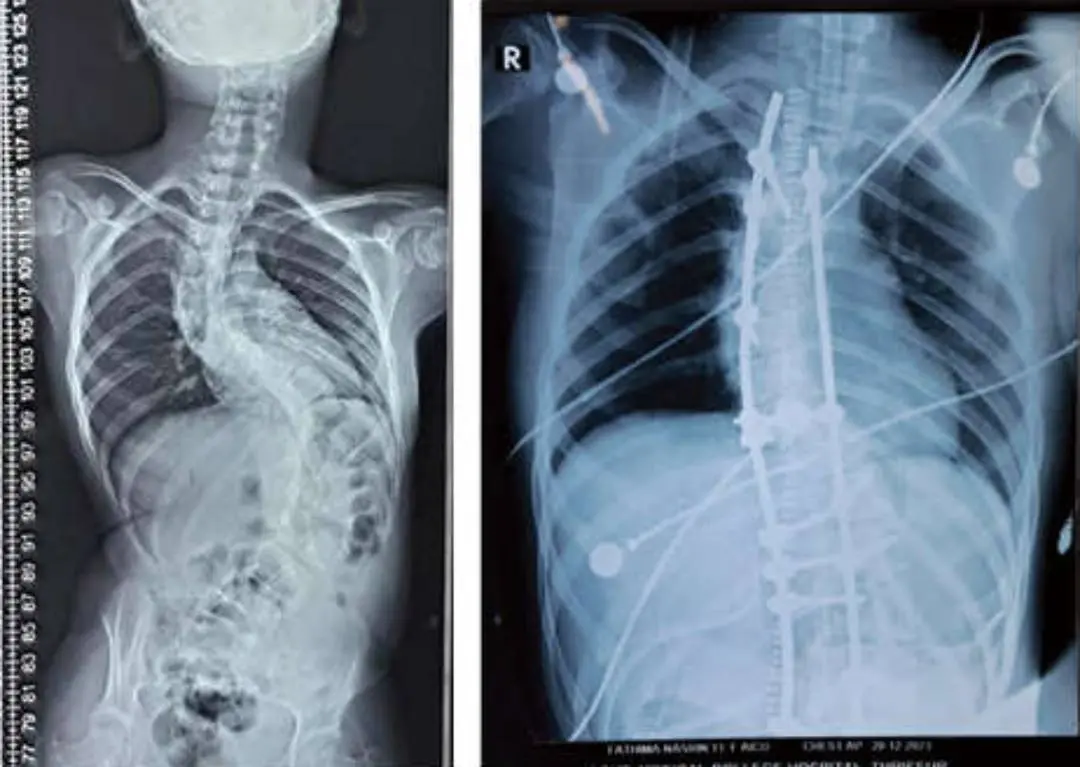 Before and after the surgery