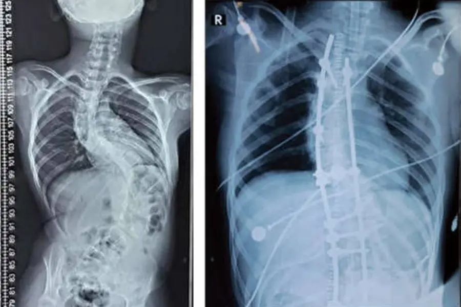 Nava Kerala Impact: 10-year-old scoliosis patient undergoes successful surgery at Thrissur MCH