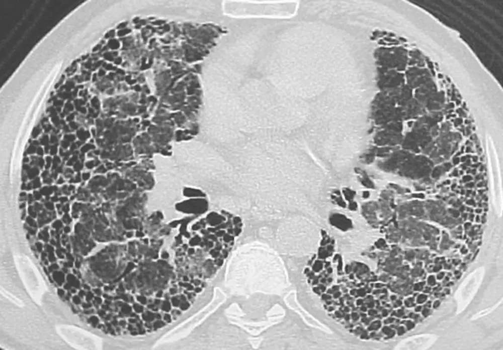Lung Fibrosis, IPF