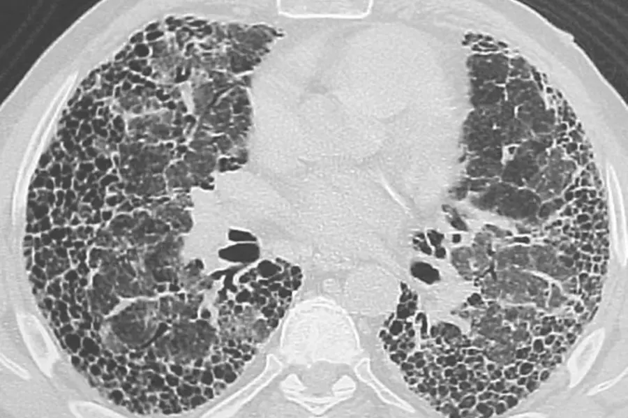 Idiopathic Pulmonary Fibrosis: A lung disorder without cure, for now
