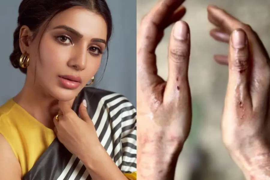 Samantha injured on sets, shares pictures of bruised hands from 'Citadel' shoot