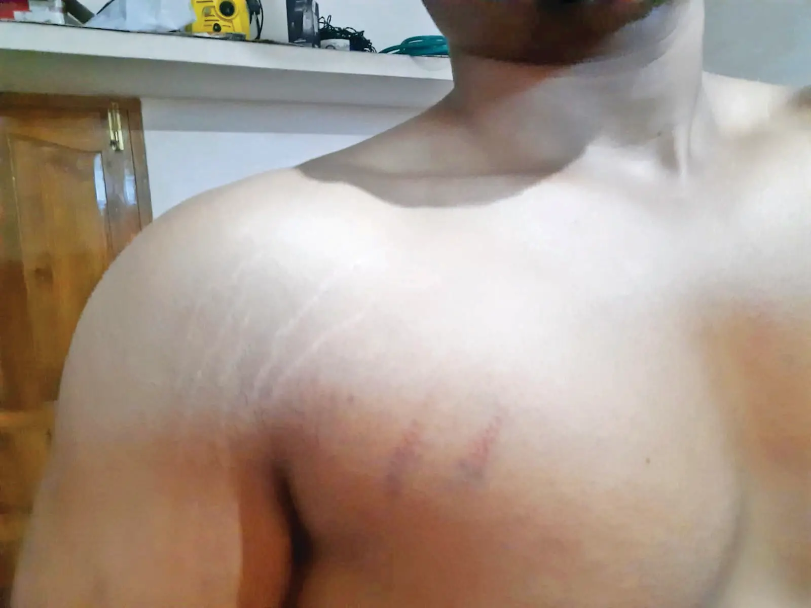 Marks on Adityan's body | Photo: Mathrubhumi