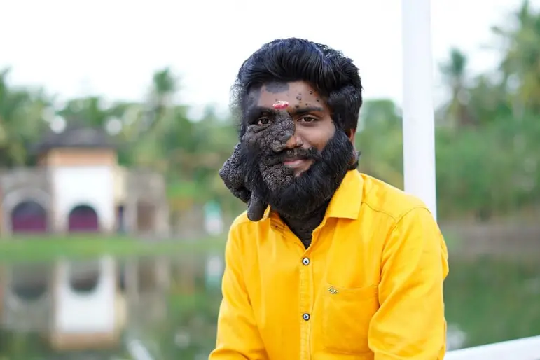 Prabhulal Prasannan, the man who fought rare cancer with a broad smile, passes away
