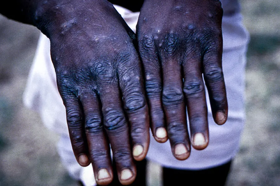 Pune: ICMR-NIV reveals Monkeypox virus strain A.2 in two UAE-returned travellers