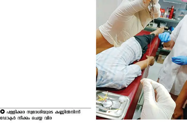 12-cm-long worm removed from 56-year-old man's eye in Kanhangad