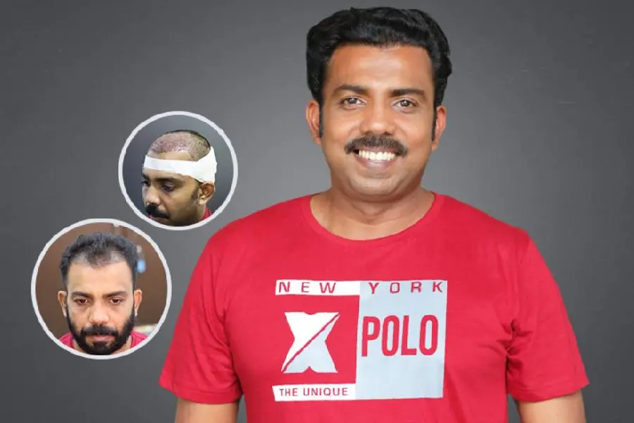 അഫോഡബിൾ റെയ്റ്റിൽ മികവുറ്റ ഹെയർ ട്രാൻസ്പ്ലാന്റ് ചികിത്സയുമായി സി.ഐ കോസ്‌മെറ്റിക് ക്ലിനിക്ക്