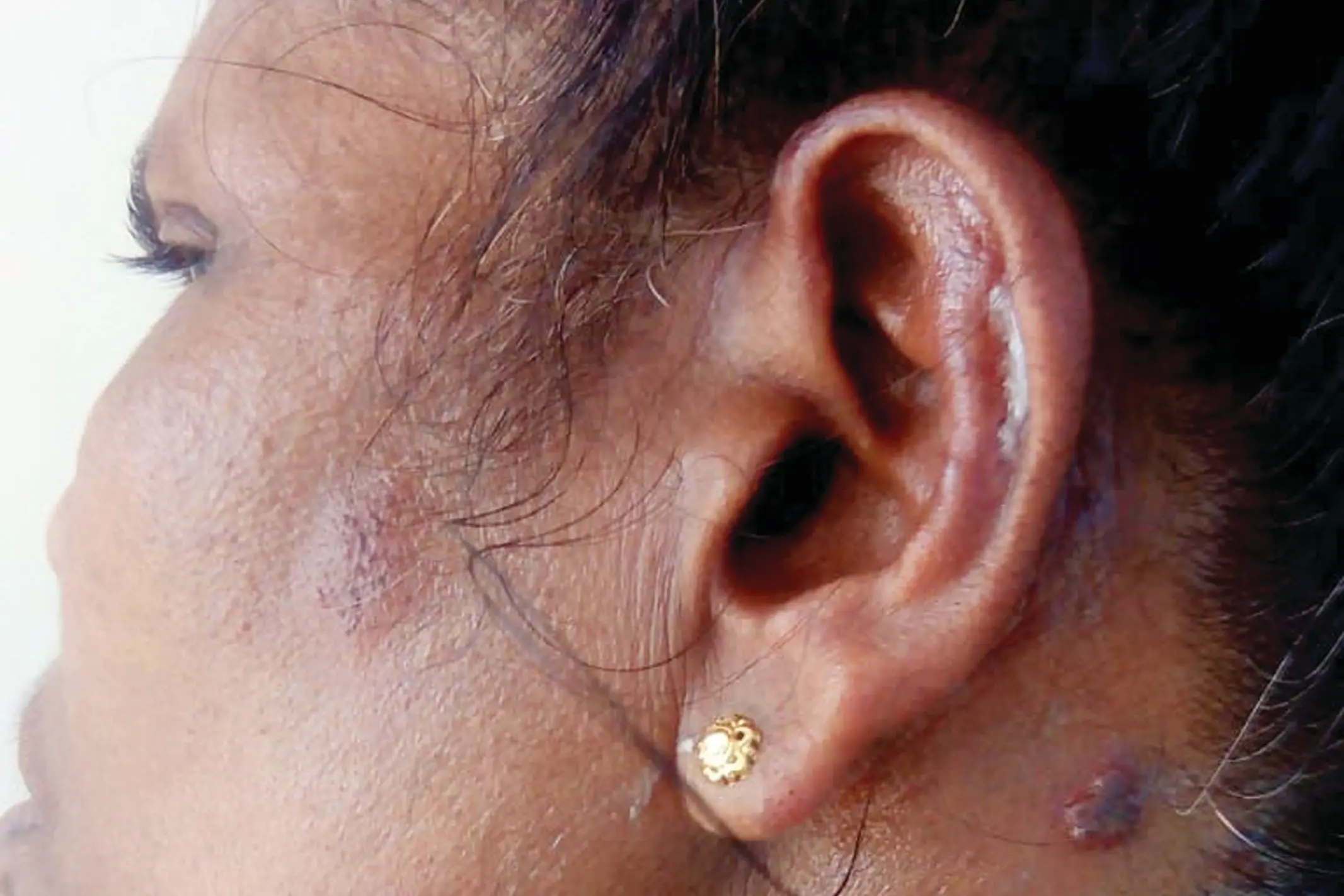 Kerala health department warns of sunburn