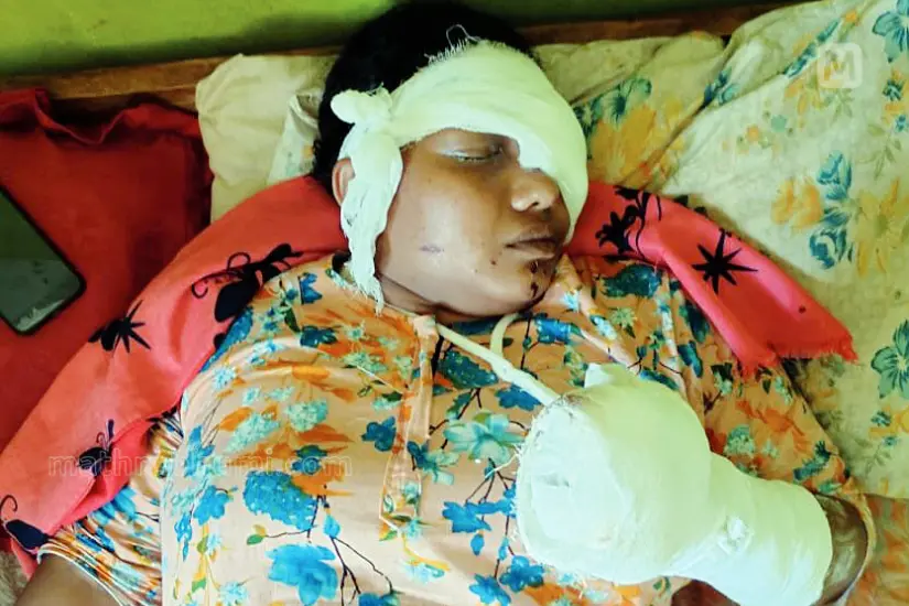 Woman loses fingers after explosive blows up while peeling areca nut in Thrissur