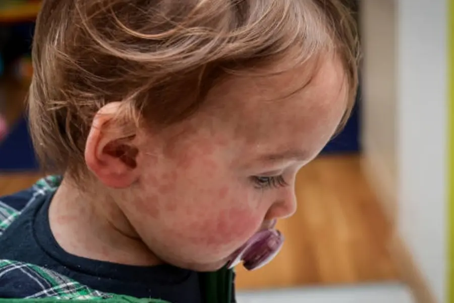 ‘Eliminated’ no more: measles returns to the US with deadly force