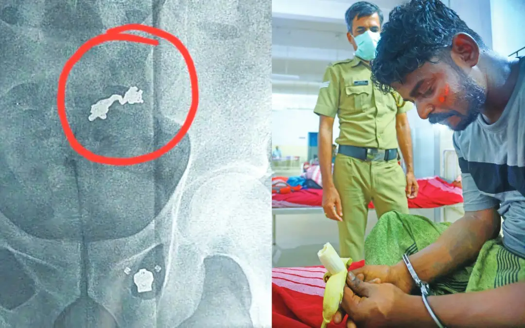 The thief who swallowed a stolen chain is under police surveillance at Palakkad hospital