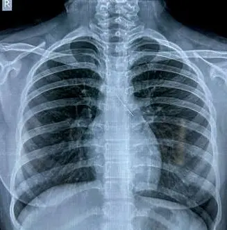 The swallowed pin found embedded in chest | Mathrubhumi