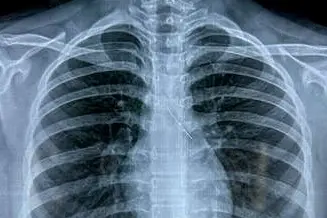Rushing for school? Doctors warn against holding pin in mouth