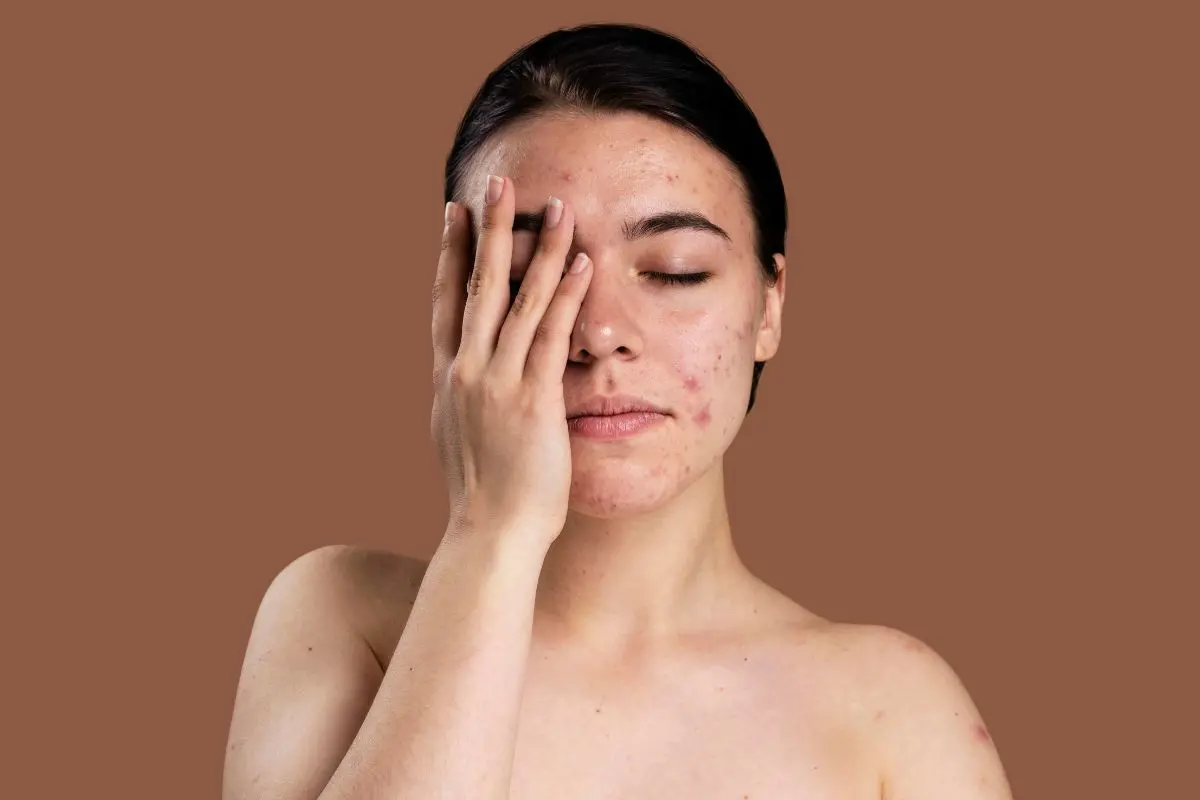 In actuality, hormonal fluctuations, heredity, and inflammation, rather than cleanliness, are the main causes of acne. Photo: Freepik