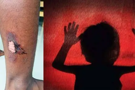 Kozhikode woman brutally tortures her 6-yr-old child for not listening to online classes attentively