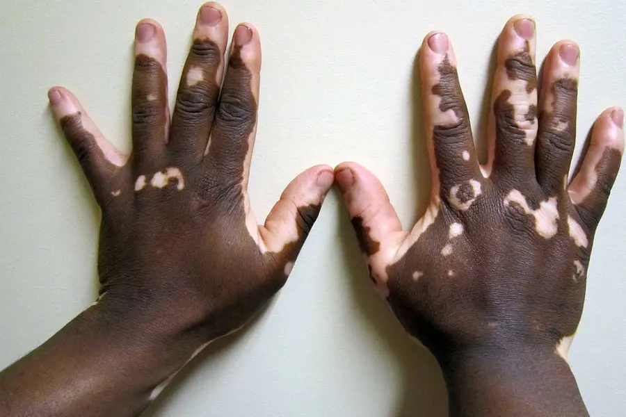 vitiligo
