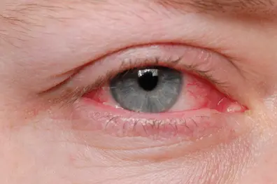 Pink eye conjunctivitis outbreak across Kerala: Key symptoms and precautions