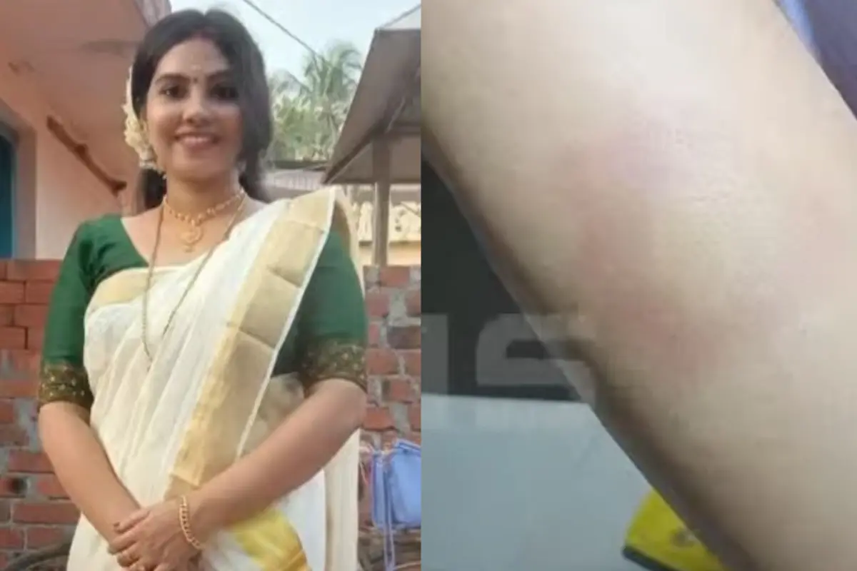 Athulya, a screengrab of a video showing a bruise on her body | Mathrubhumi