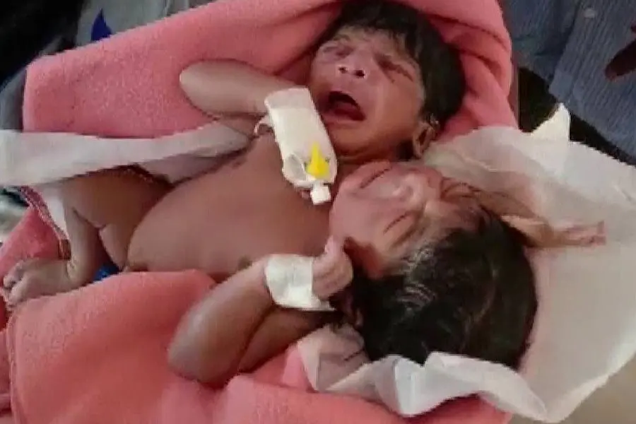 ഒട്ടിച്ചേര്ന്ന ശരീരവും രണ്ട് തലകളും മൂന്ന് കൈകളുമായി ഇരട്ട കുട്ടികള് ജനിച്ചു