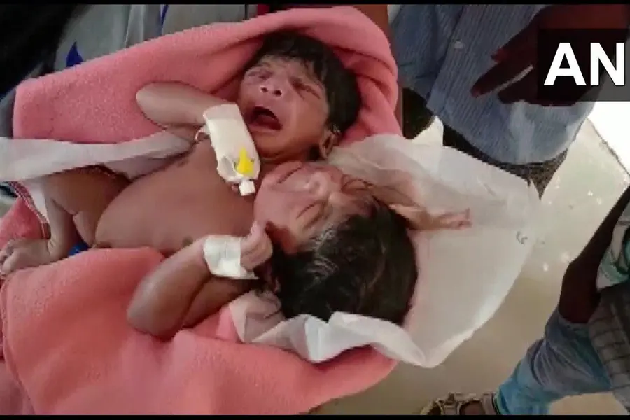 രണ്ട് തലയും മൂന്ന് കൈകളും; ഒഡിഷയില് യുവതി ജന്മം നല്കിയത് അപൂര്വ ഇരട്ടകള്ക്ക്