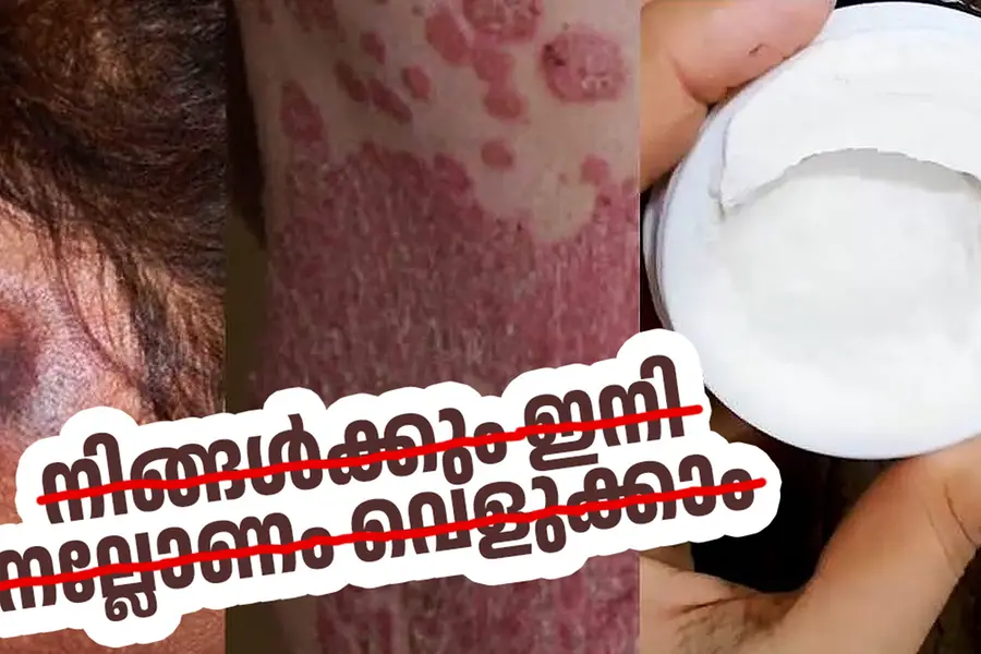 ബ്രിട്ടീഷുകാരെപ്പോലെ വെളുക്കുമെന്ന് വാഗ്ദാനം; സോഷ്യൽ മീഡിയയിൽ പൊടിപൊടിച്ച് ക്രീം വിൽപന