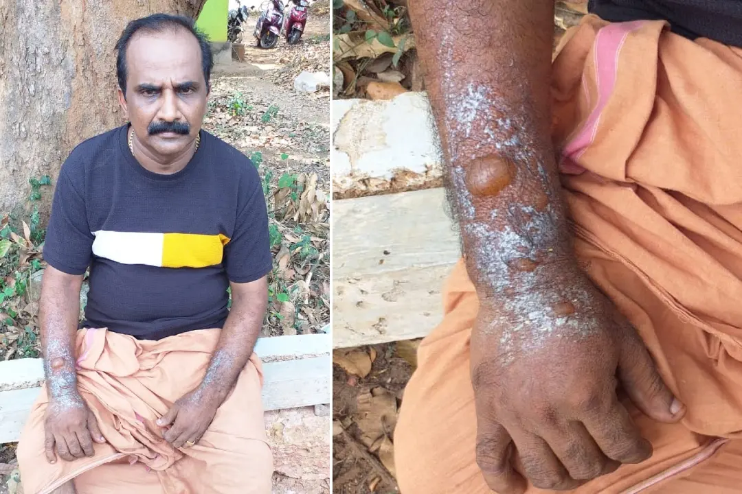 രതീഷിന്റെ കൈയിൽ സൂര്യാതപമേറ്റപ്പോൾ