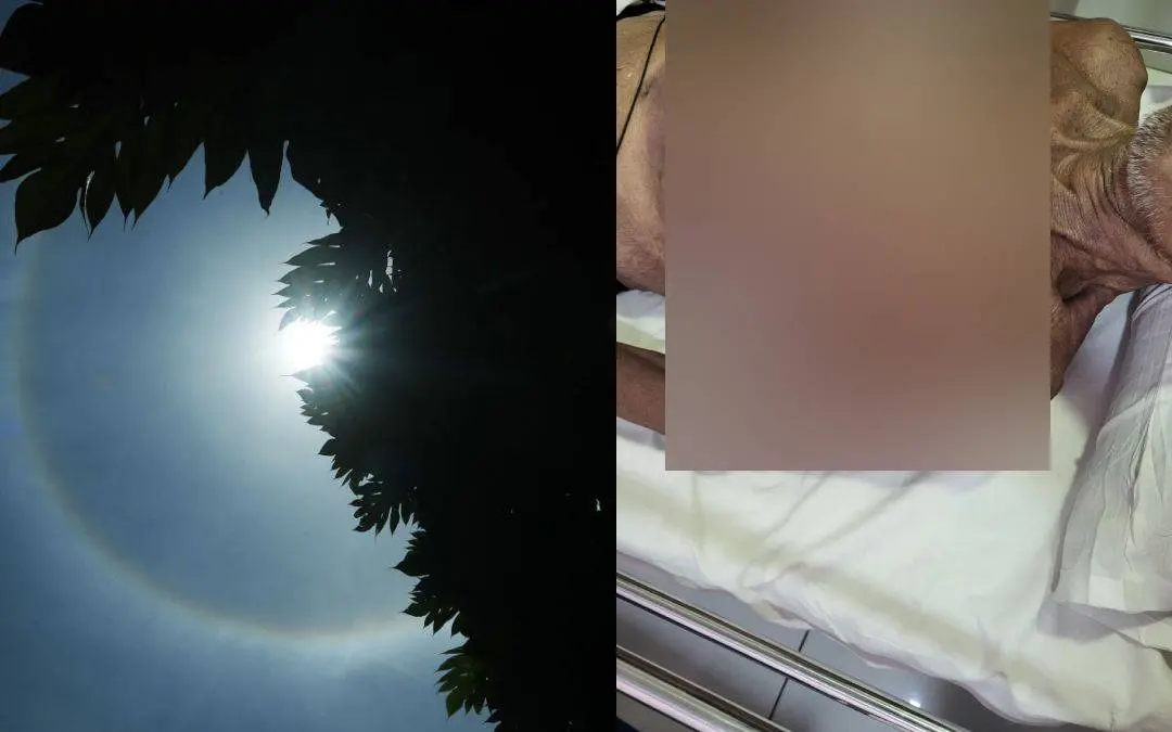 പ്രതീകാത്മക ചിത്രം, മരിച്ച കണ്ണന്റെ ശരീരത്തിലേറ്റ പൊള്ളല് | Photo: Mathrubhumi, Special Arrangement