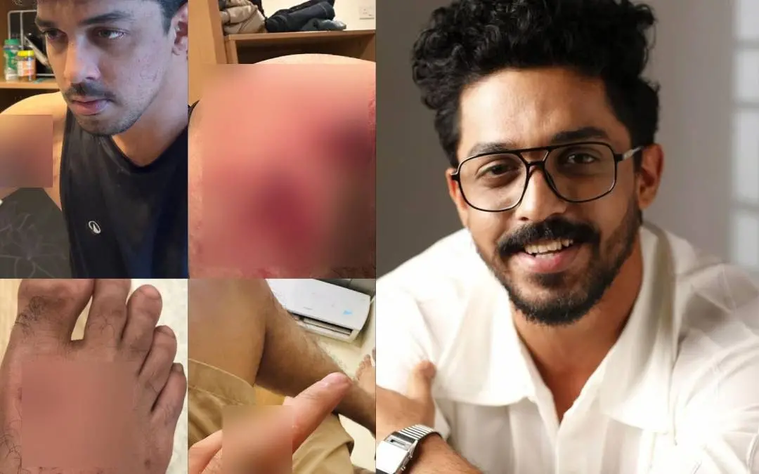 നടന്റെ പരിക്കുകള്, സാഗര് സൂര്യ | Photo: Special Arrangement, Instagram/ Sagar Surya