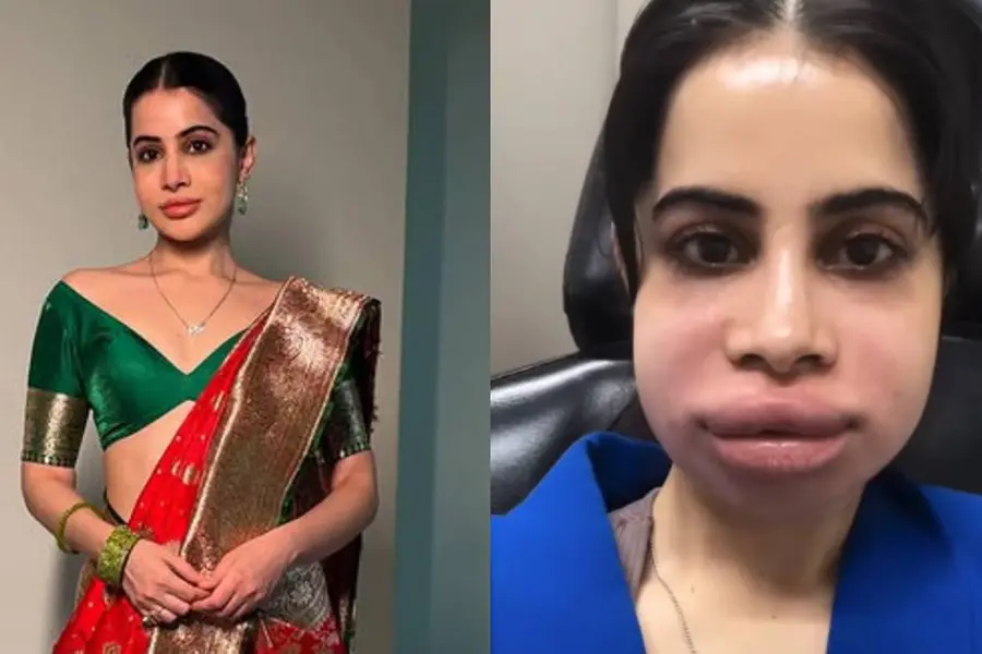 ഫില്ലറുകൾ ഡിസോൾവ് ചെയ്തു, മുഖം വീർത്തു; കാണുമ്പോൾ പോലും അസഹ്യമായ വേദന തോന്നിയേക്കാം- ഉർഫി ജാവേദ്