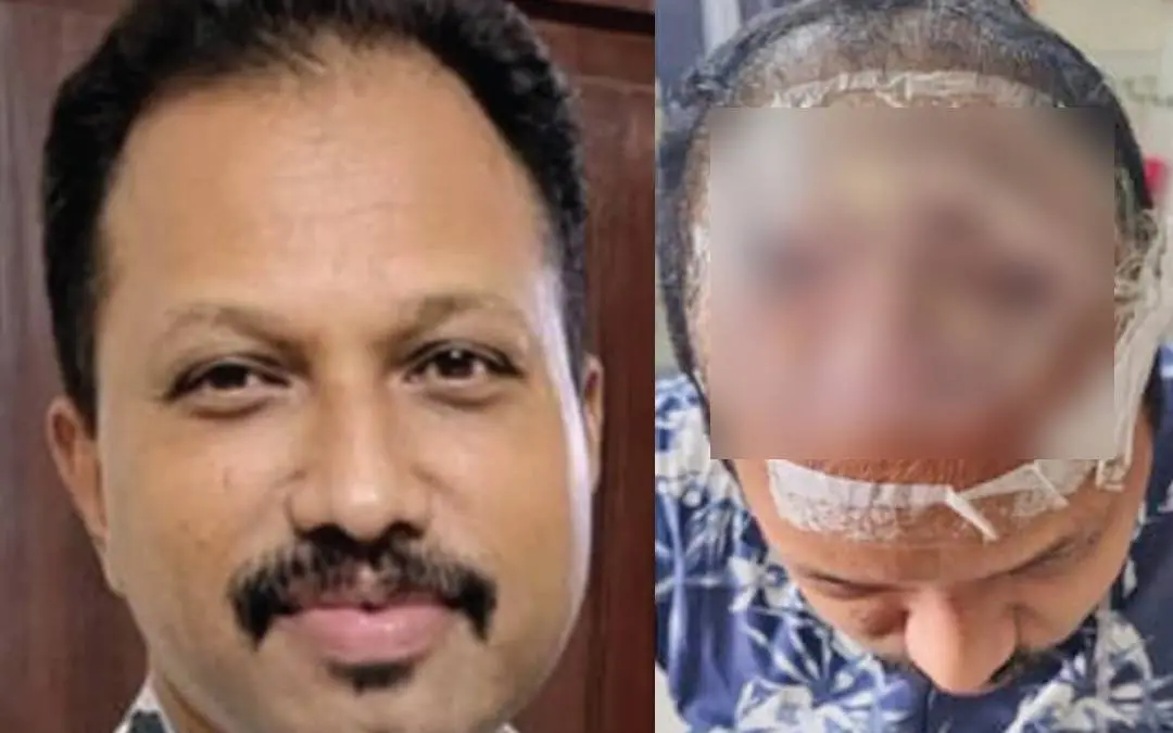 സനിൽ മുടിവെച്ചുപിടിപ്പിക്കുന്ന ചികിത്സയ്ക്ക് മുൻപ്, മുടിവെച്ചുപിടിപ്പിക്കുന്ന ചികിത്സയ്ക്കുശേഷം തലയ്ക്ക് അണുബാധയേറ്റ് ചികിത്സയിൽ കഴിയുന്ന സനിൽ