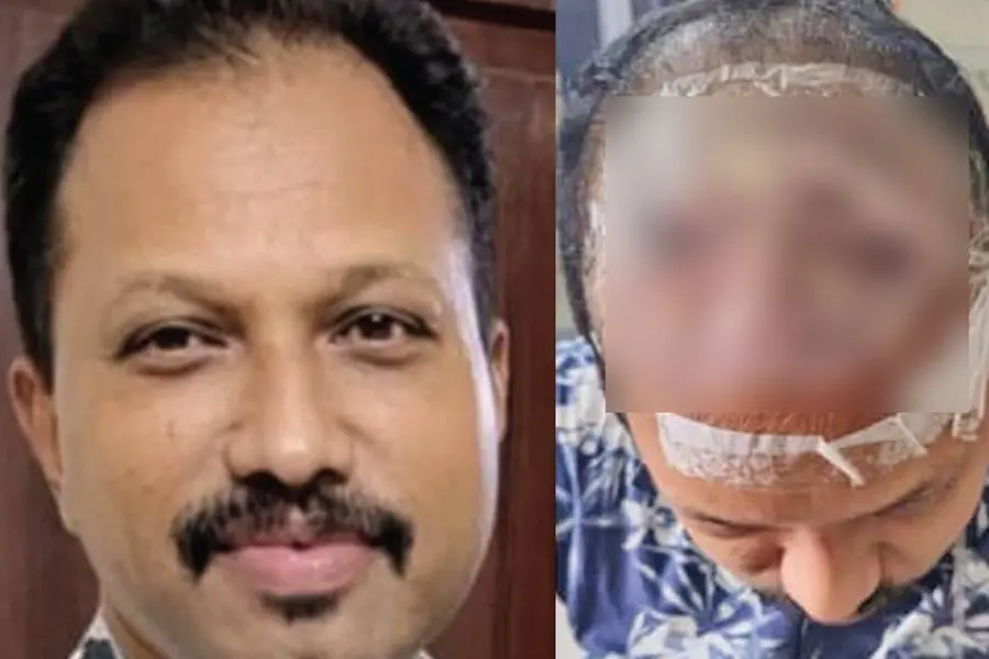 തലയിൽ മുടിവെച്ചുപിടിപ്പിച്ചു, പിന്നാലെ അസഹ്യമായ വേദന, അണുബാധയേറ്റ യുവാവ് ദുരിതത്തിൽ