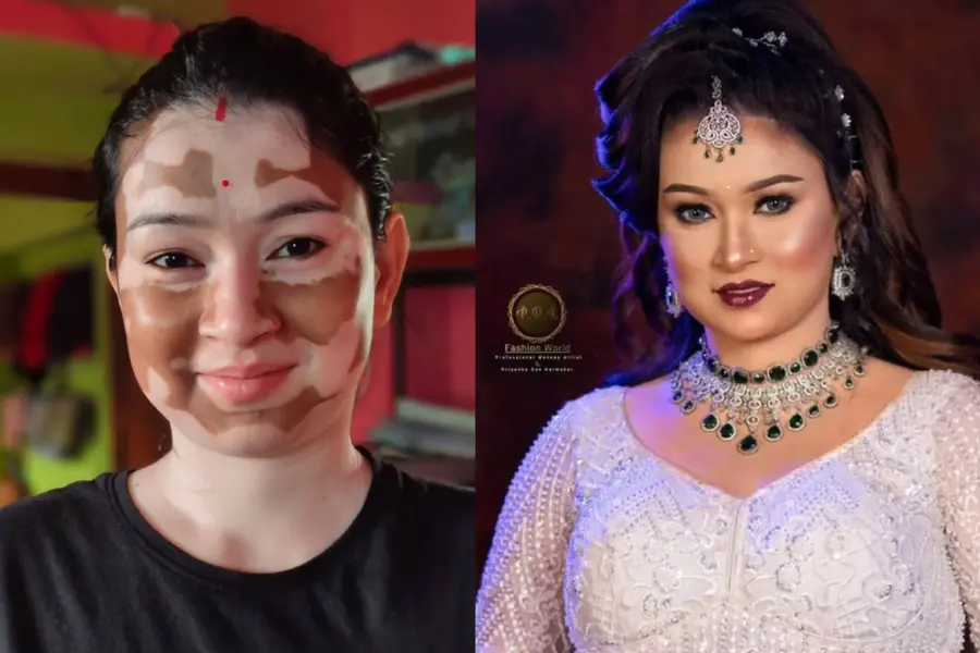മുറിവ് ഉണങ്ങിയപ്പോഴാണ് വെള്ളപ്പാണ്ട് തിരിച്ചറിഞ്ഞത്; നിന്നെപ്പോലെ ഒരു കുഞ്ഞിനെ വേണ്ടെന്ന് അവർ പറഞ്ഞു