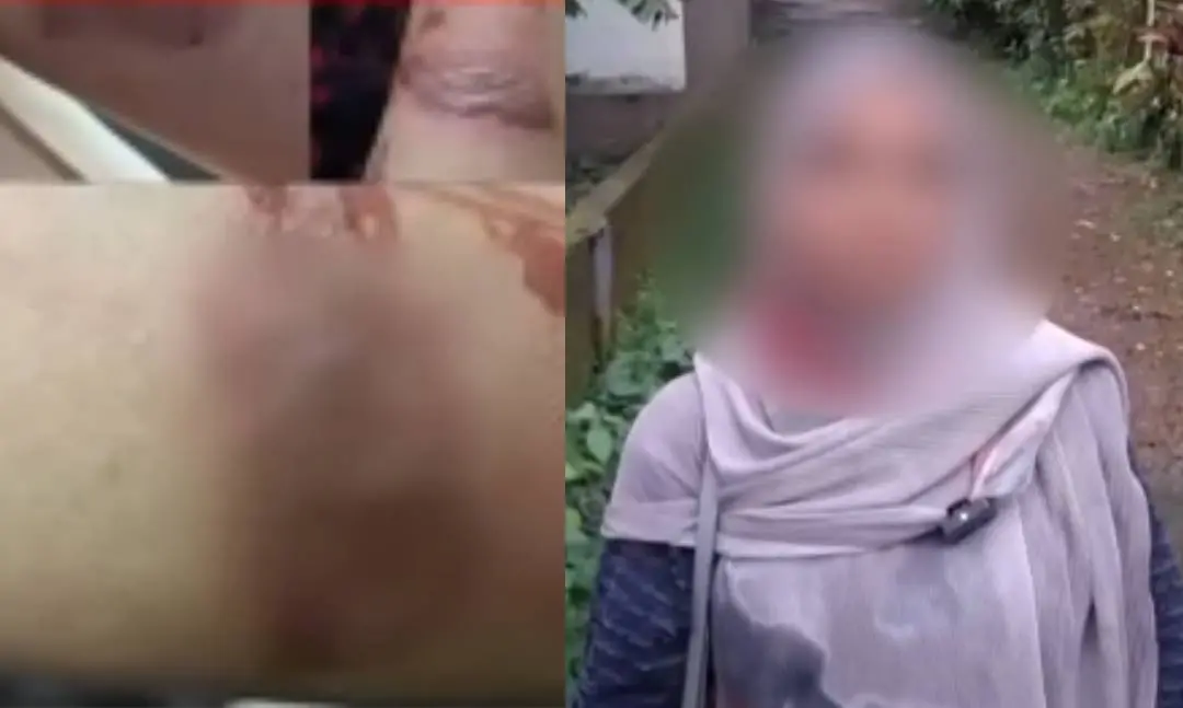 യുവതിയുടെ കെെ പൊള്ളിയനിലയിൽ