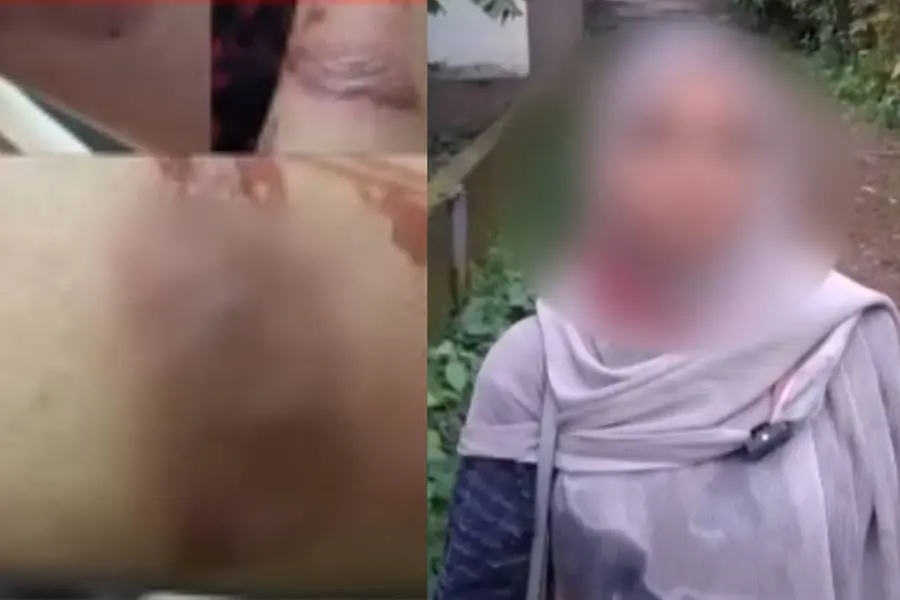 ഭിന്നശേഷിക്കാരിയുടെ കൈ ചൂടുവെള്ളം ഒഴിച്ച് പൊള്ളിച്ചതായി പരാതി; അധ്യാപികയ്ക്കെതിരെ പരാതി