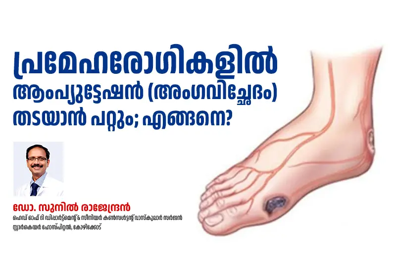 പ്രമേഹരോഗികളിൽ ആംപ്യുട്ടേഷൻ (അംഗവിച്ഛേദം) തടയാൻ പറ്റും; എങ്ങിനെ?