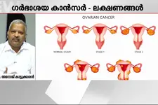 സ്ത്രീകളെ മാത്രം ബാധിക്കുന്ന അർബുദങ്ങളും കാരണങ്ങളും - ഡോക്ടറോട് ചോദിക്കാം